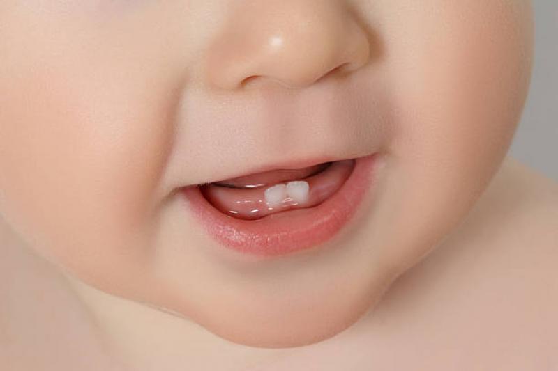 9 Gejala Tumbuh Gigi pada Bayi