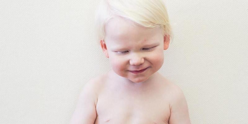 Penyebab, Ciri, Risiko Komplikasi, dan Perawatan Anak yang Terlahir Albino