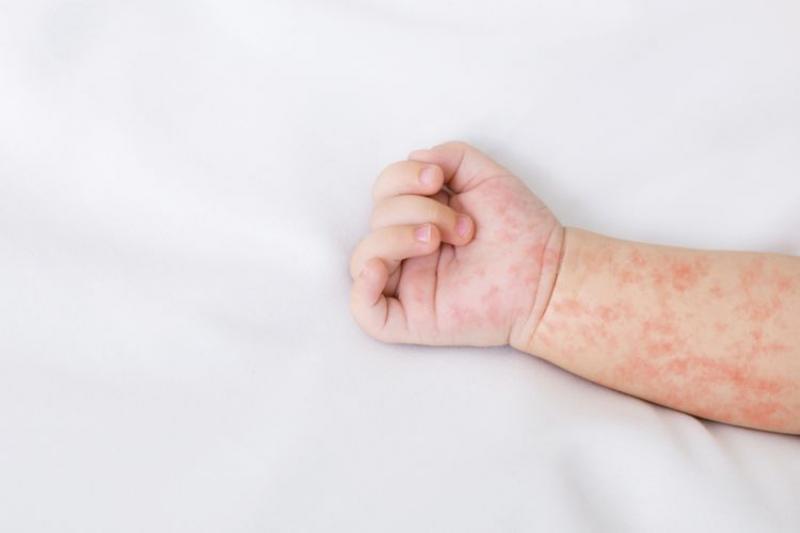 Perbedaan Campak dan Alergi pada Anak, Gatal Salah Satunya?