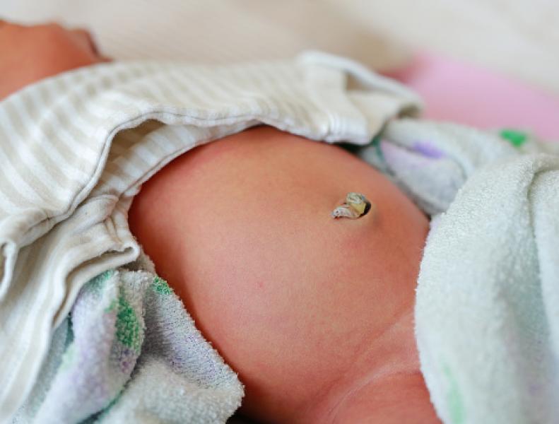 Tips Merawat Tali Pusar Bayi Pasca Pemotongan Agar Cepat Mengering